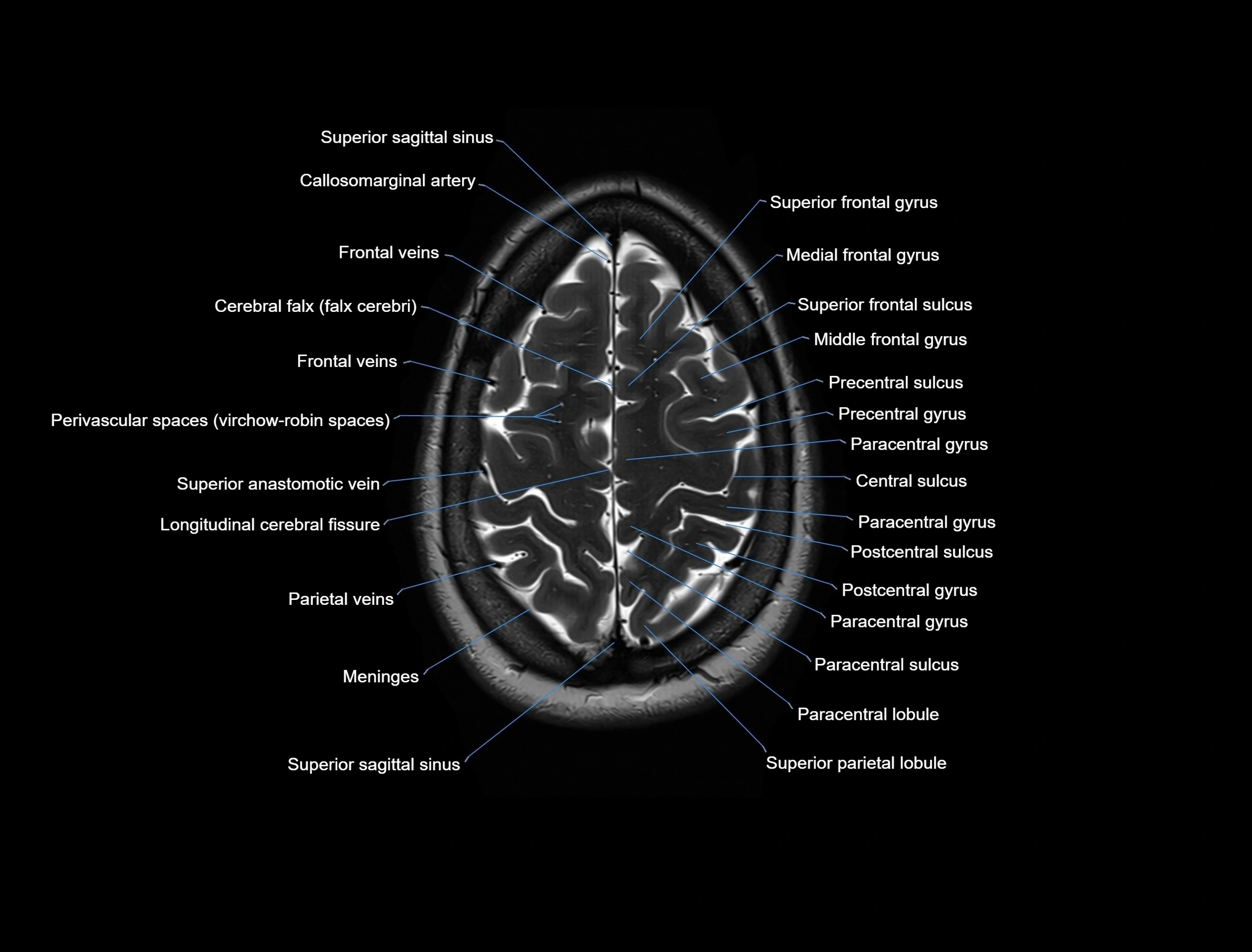 MRI Brain axial cross sectional radiology anatomy 3T image  -img-00001-00050.webp